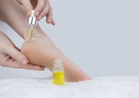 Cracked heels. Woman feet before and after procedures to soften rough skin. Urea cream, oil for care of keratinized skin, healing of cracked foot. Usage foot grater, cream with urea, softening oil.の写真素材