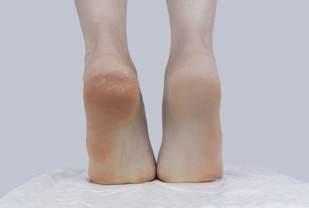 Cracked heels. Woman feet before and after procedures to soften rough skin. Urea cream, oil for care of keratinized skin, healing of cracked foot. Usage foot grater, cream with urea, softening oil.の写真素材