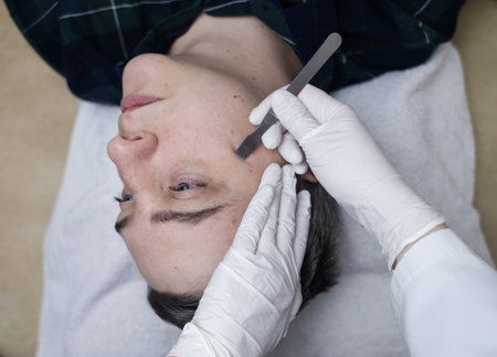 A dermatologist takes a skin scraping and tests for demodicosis and dermatitis, fungal infection. Close-up of a male patient's face at a doctor's appointmentの写真素材