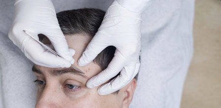 A dermatologist uses tweezers to take a scraping of a male patient's eyebrows for a demodex test. Dermatological examination and diagnosis of skin parasites and mites.の写真素材