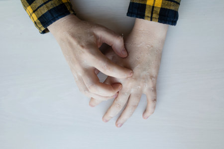 Dry skin on hands. Women's dry hands with peeling, erosions and cracks. Cream for skin dermatological diseasesの写真素材