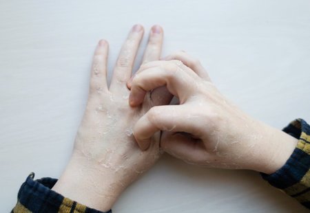 Dry skin on hands. Women's dry hands with peeling, erosions and cracks. Cream for skin dermatological diseasesの写真素材