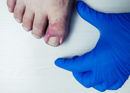 Finger infection. Paronychia, onychomycosis, nail psoriasis, longitudinal melanonychia, onychomadesis and retronychia. Inflammation of the big toe. Treatment of purulent diseases.の写真素材