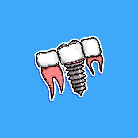 Illustration of Dental Implant with Attachment Screws and Teeth Graphic on Blue Backgroundのイラスト素材