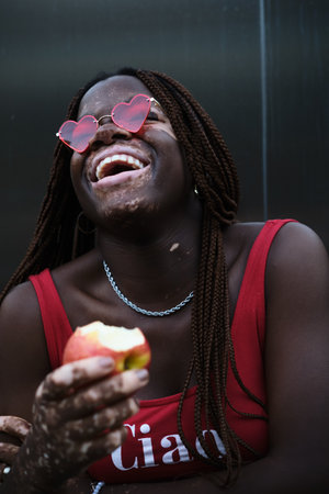 African American woman with vitiligo wearing sunglasses and laughing while holding a bitten apple.