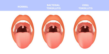 Open mouth, normal and Tonsillitis bacterial and viral. Angina, pharyngitis and tonsillitis. Infection of tonsils.のイラスト素材