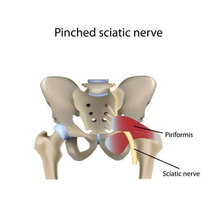 Pinched sciatic nerve, vector medical illustration vectorのイラスト素材