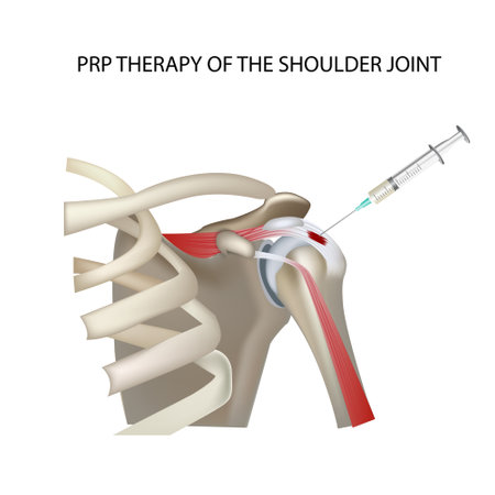 PRP therapy of the shoulder joint, vector medical illustration vectorのイラスト素材