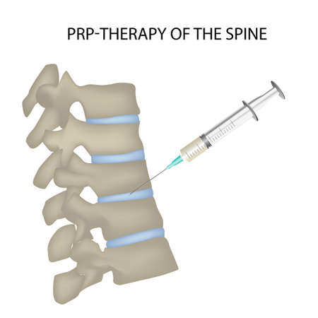 PRP spine therapy, vector medical illustration vectorのイラスト素材