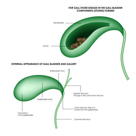 The structure of the gallbladder and stones in the gallbladder. Realistic medical illustration.のイラスト素材