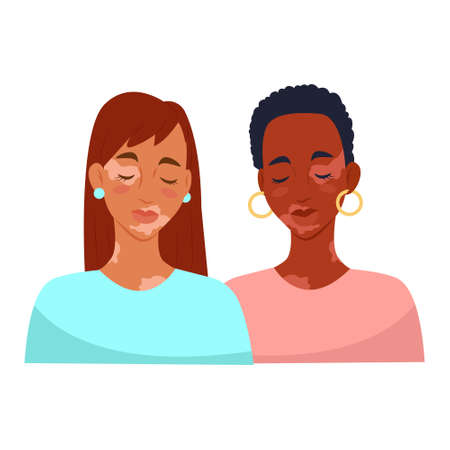 Two women with vitiligo. Vitiligo skin disease. Vector illustrationのイラスト素材