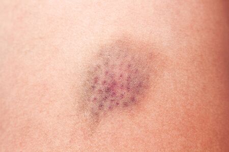 Bruise wounded texture on asian woman leg skin background