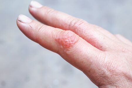 Close up allergy symptom many red rash and blister on finger right hand  woman after used alcohol...