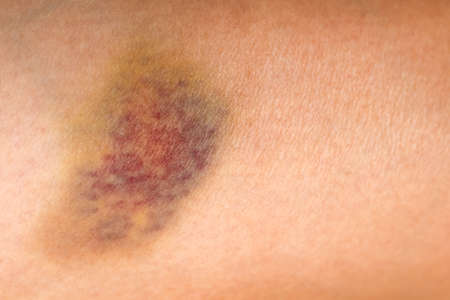Bruise wounded  skin texture of asian woman on leg skin body path background