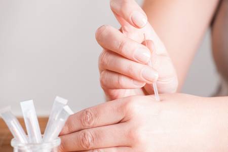 Hand applying acupuncture needle in a point called Hegu  の写真素材