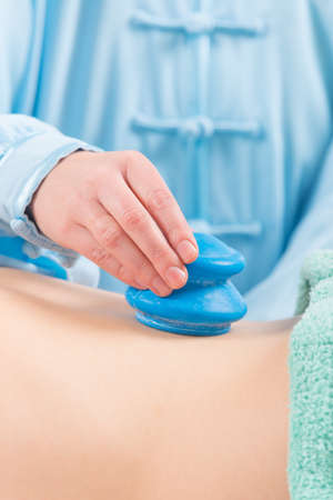 Therapist doing traditional chinese cupping therapy on her patientの写真素材