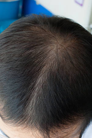 Human alopecia or hair loss - adult man bald head rear or back viewの写真素材