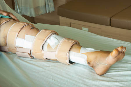 woman wearing a leg brace, Broken legの写真素材