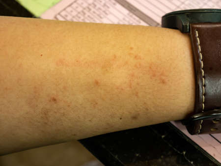 Symptoms of itchy urticaria or Dermatitis on skinの写真素材