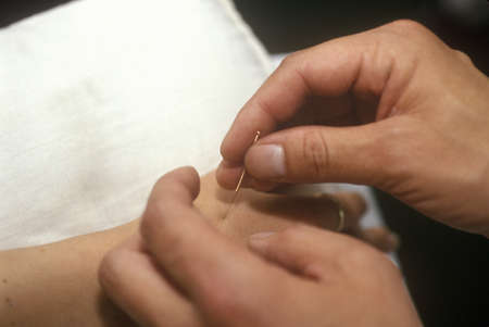 Acupuncture therapy at Yunnan College of Traditional Chinese Medicine in Kunming, People's Republic of Chinaのeditorial素材