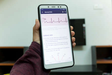 Negeri Sembilan, Malaysia - August 30, 2018: Dailyrounds application on smartphone. It is an application to help medical students in daily hospital rounds. Screen shows normal ECG of a patient.のeditorial素材