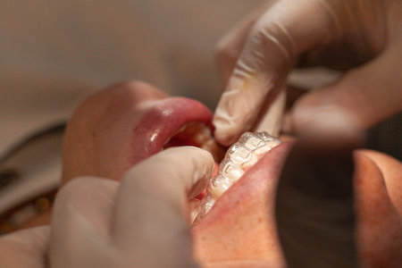 Close-up of an orthodontic specialist adjusting and placing invisible aligners on a Latina woman....