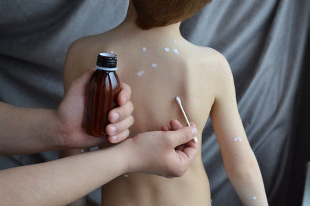 Infectious diseases, chickenpox. Dad administering antipruritic white lotion to the virus for smallpox symptoms on the child's.の写真素材