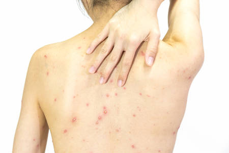 Closeup of girl back of blisters, scar and rash caused by Varicella virus or Chicken Pox on white background.の写真素材