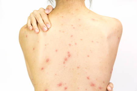 Closeup of girl back of blisters, scar and rash caused by Varicella virus or Chicken Pox on white background.の写真素材