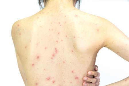 Closeup of girl back of blisters, scar and rash caused by Varicella virus or Chicken Pox on white background.の写真素材