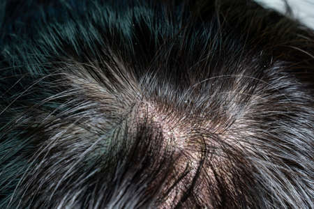 Skin diseases, on the scalp ,Woman with dandruff in her dark hairの写真素材