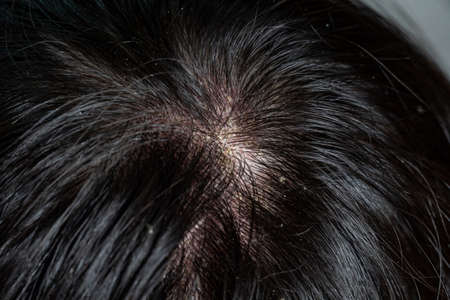 Skin diseases, on the scalp ,Woman with dandruff in her dark hairの写真素材