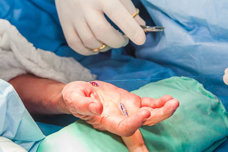 Surgeon suturing the hand of a patient at the end of surgeryの写真素材