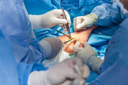 Group of surgeons performing an elbow surgeryの写真素材