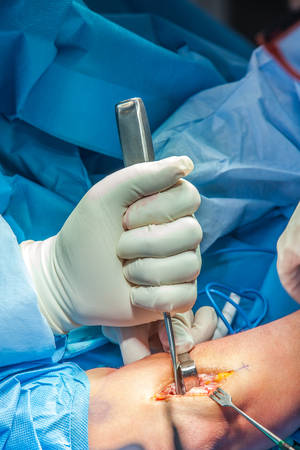 Group of surgeons performing an elbow surgeryの写真素材