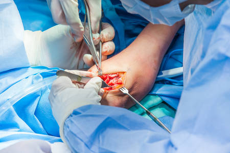 Group of surgeons performing an elbow surgeryの写真素材