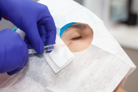 Skin lesion removal procedure. Dermatologist carrying out a removal of benign skin lesion on the...