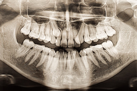 Panoramic dental X-Ray