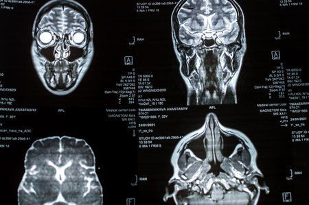 Magnetic resonance imaging of the brain close up. MRI