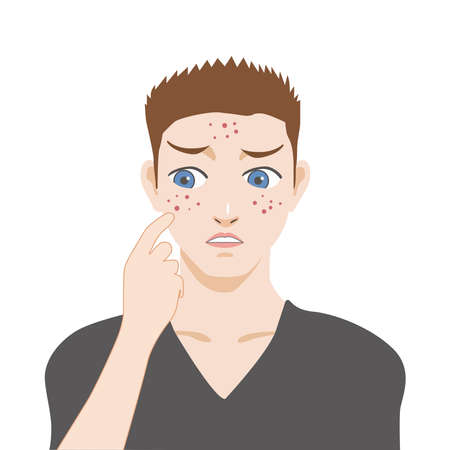 Picture of a guy with acne on a white background.のイラスト素材