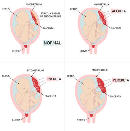 Placenta accreta. part of placenta attaches abnormally to the myometrium. Three grades of abnormal attachment illustrated according to the depth Accrete, increta, percreta. colored medical vector illustrationのイラスト素材
