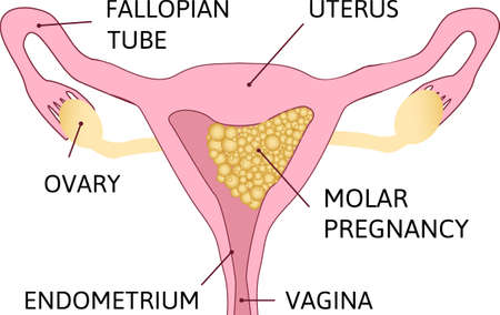 Molar pregnancy, abnormal form of pregnancy. Many grapes in uterine cavity. Human realistic uterus. Anatomy illustration. Colored image, white background.のイラスト素材