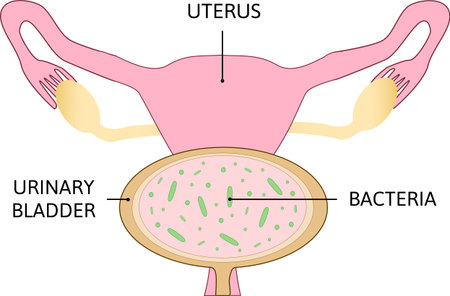 Vector of urinary tract infection. - ID:1-144158247 - Royalty Free ...