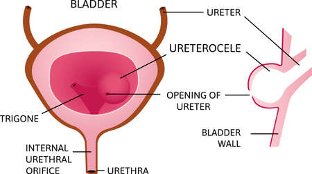 urinary bladder or simply bladder with ureterocele. it is forming a sac-like pouch. every part are marked with title. simple vector illustration. Anatomy and health. Pink and brown colors.のイラスト素材