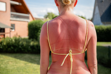 Back view of a woman with red sunburn and bikini tan lines, skin care and sun exposure conceptの写真素材