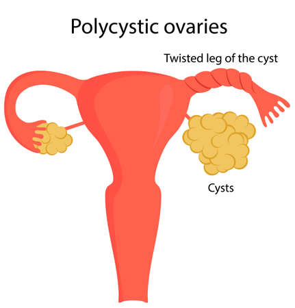 Vector illustration of twisted leg of the cyst.のイラスト素材