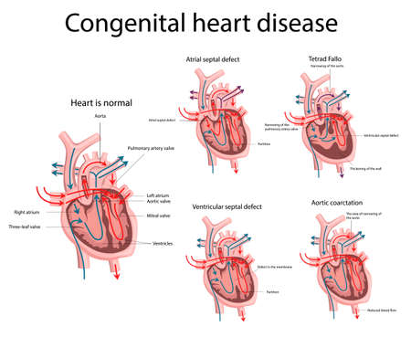 Vector illustration of Congenital heart disease. Heart diseaseのイラスト素材