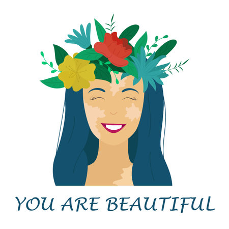 Portrait of a smiling girl with vitiligo. World Vitiligo Day. A different kind of beauty. skin diseases. Accept and love yourself. Vector illustration with the inscription You are beautiful.のイラスト素材