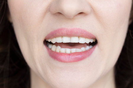 Woman shows off her chipped teeth. Bruxism, stress, malocclusion.