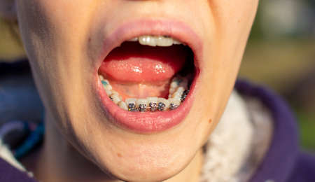 brasket system in smiling mouth, macro photo teeth, close-up lips, macro shot.の写真素材